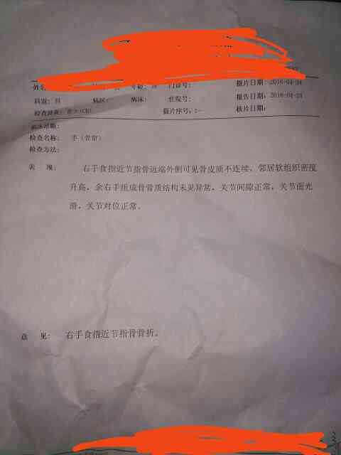 手指尖骨裂工伤等级判定及赔偿标准详解