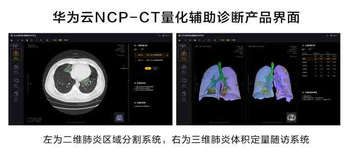 ct检查报告ai是什么意思 ct检查报告ai是什么意思