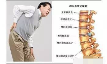 搬重物不当导致腰椎间盘突出与膨出：预防措与治疗方法解析