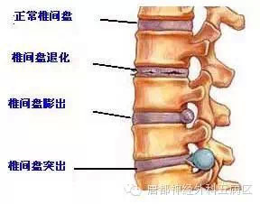 搬重物腰椎膨出认定工伤