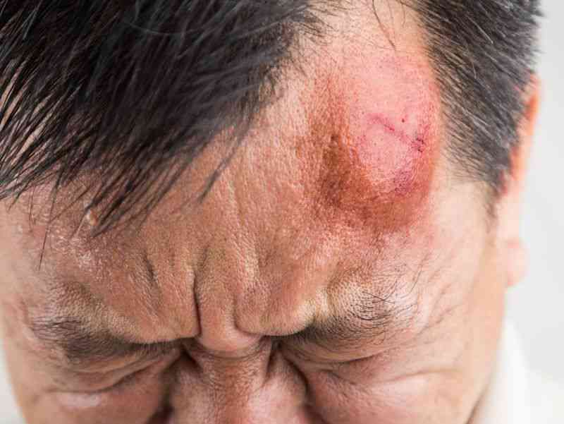 头部摔伤后的紧急处理与后续护理指南
