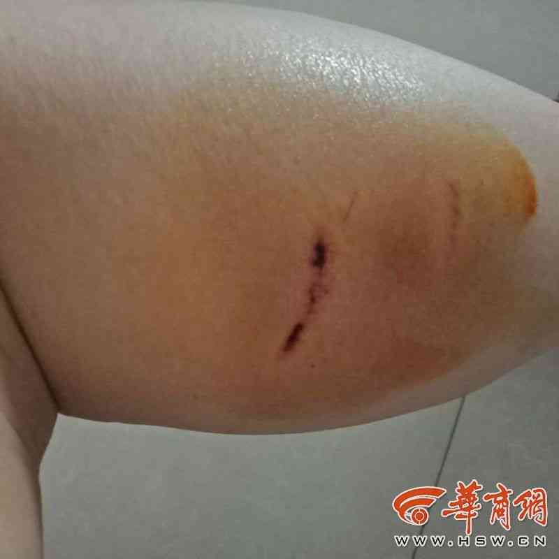 皮肤擦伤是否构成轻伤：专业解读与判定标准