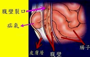 斜疝认定工伤：详解疝气如何被划分为工伤的情形