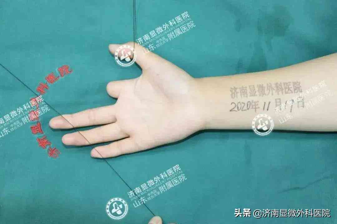 工伤等级评定：断手指工伤伤残级别划分及赔偿标准解析