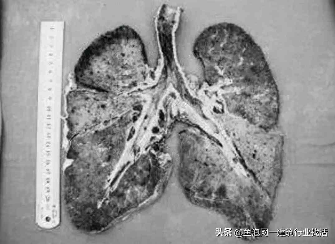 尘肺病工伤认定全解析：早期尘肺能否被认定为工伤及所需条件
