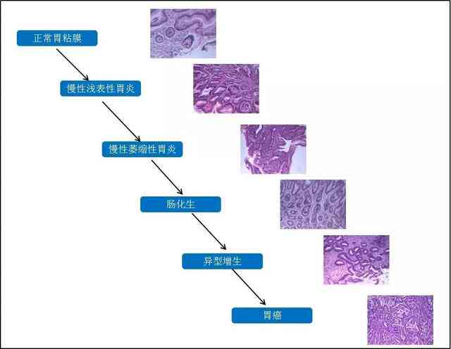 胃镜报告中C1C2标记缺失的原因解析