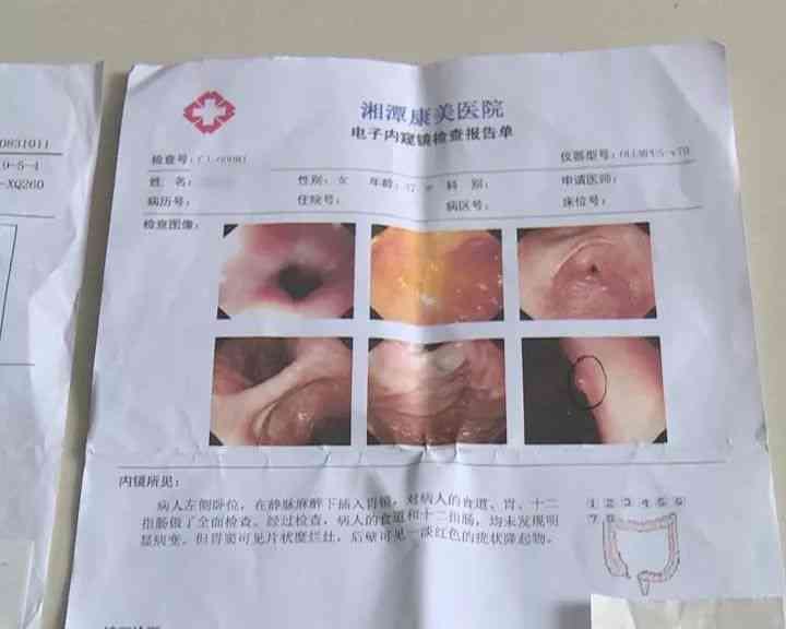 胃镜报告单上有胃粘膜欠光起中间凹陷严重吗：分析症状与潜在健风险
