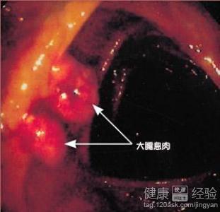 矽肺晚期可以活多久：晚期寿命、治疗方法及临死症状解析
