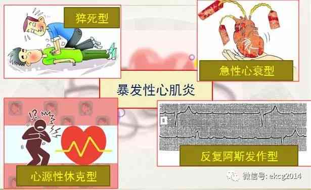 暴发性心肌炎发作所致死亡：探讨其工伤认定的合理性与必要性