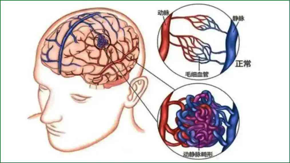 脑血管畸形是否属于工伤：认定标准、条件及法律解读
