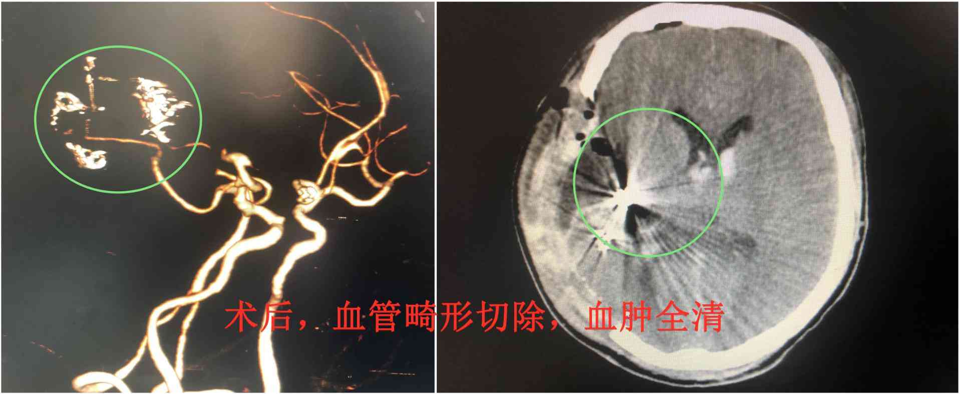 警惕脑血管畸形：日常工作与生活中应如何自我防护与调适
