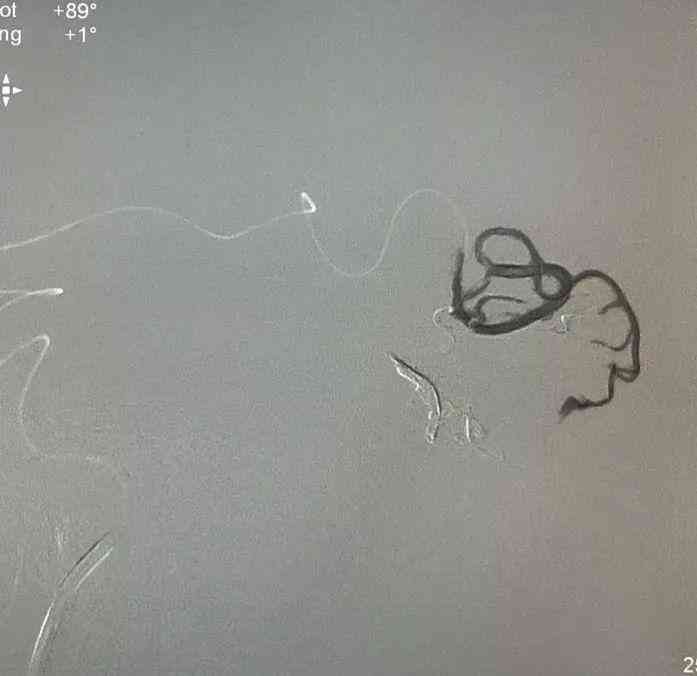警惕脑血管畸形：日常工作与生活中应如何自我防护与调适