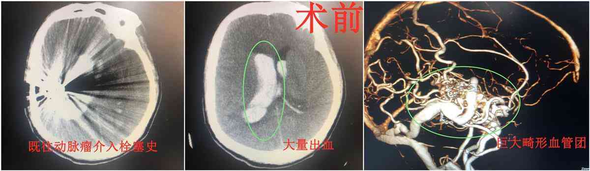 警惕脑血管畸形：日常工作与生活中应如何自我防护与调适