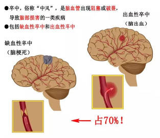 探秘脑血管畸形：发病率解析与高风险人群全面解读