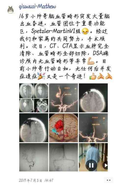 无意发现脑血管畸形：10岁儿体检疑似，如何治疗及治愈可能性探讨