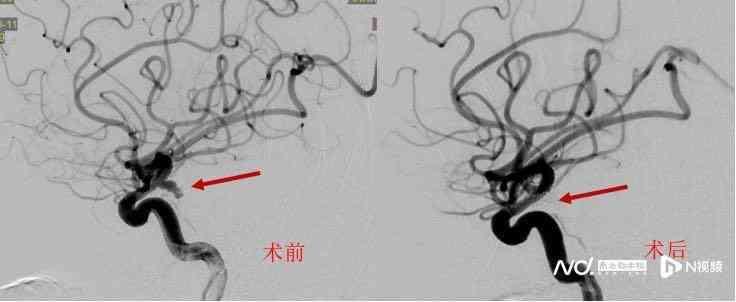 无意发现脑血管畸形：10岁儿体检疑似，如何治疗及治愈可能性探讨