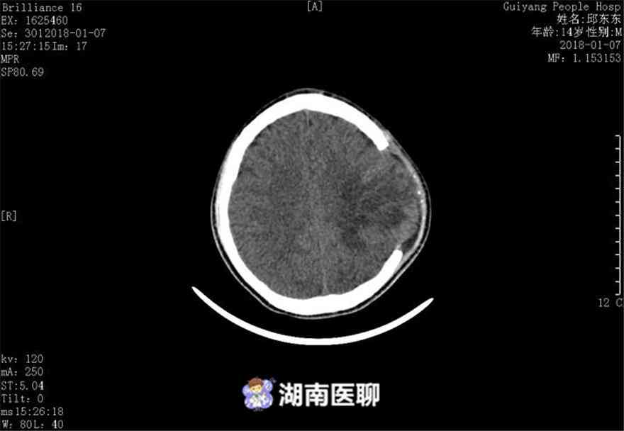 国人脑血管畸形发生率解析：探究发病率与风险因素