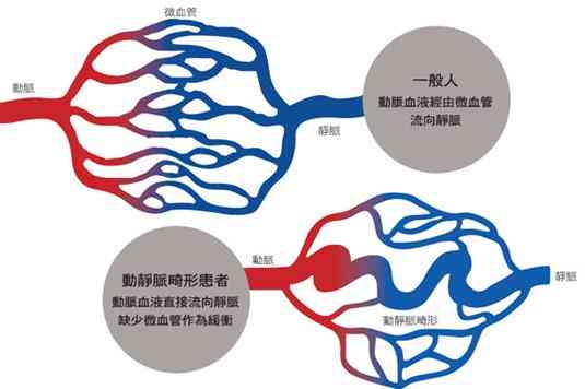 有脑血管畸形能认定工伤