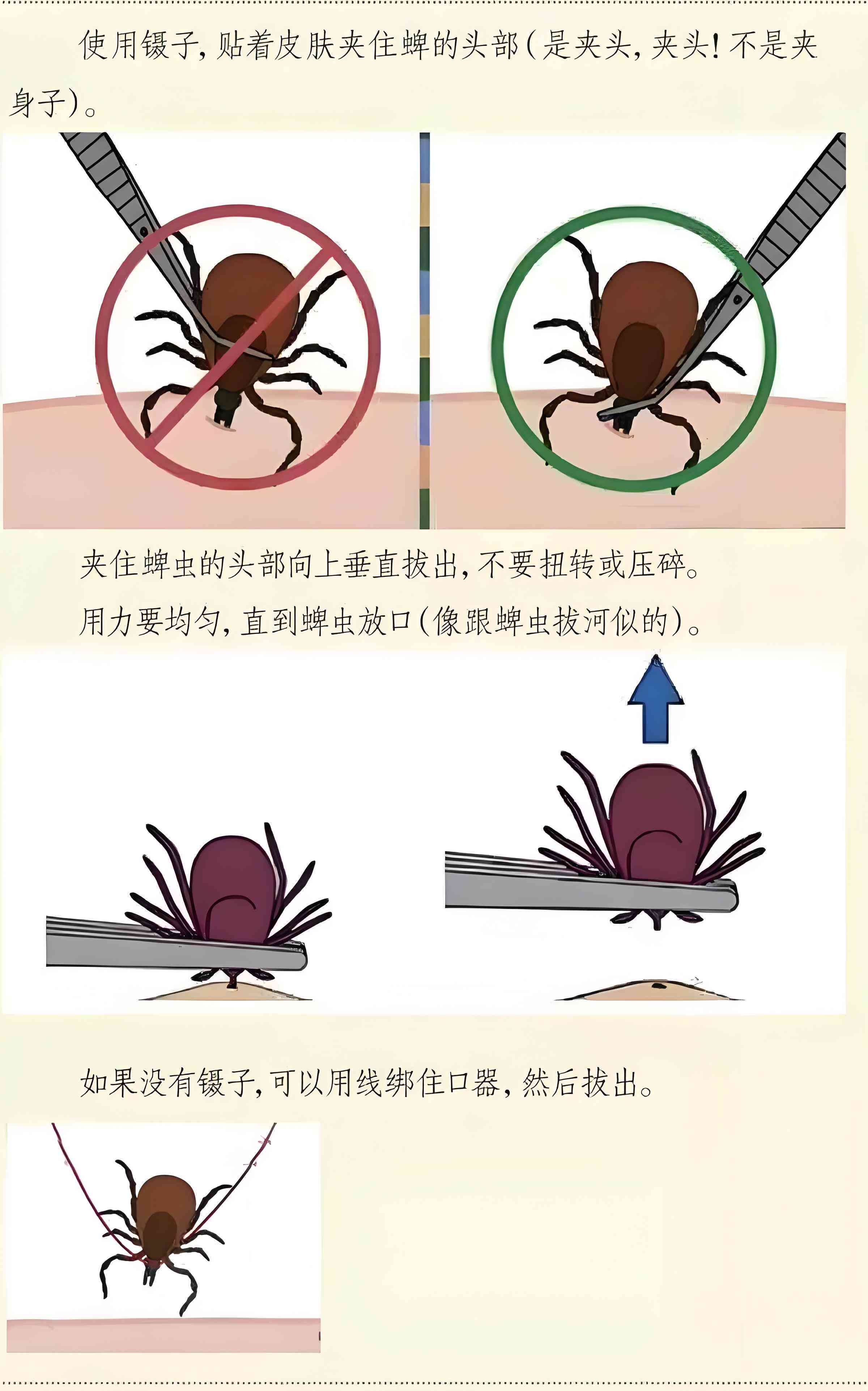 工伤认定：蜱虫咬伤职业暴露如何处理与认定标准
