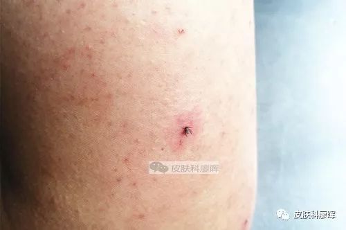 工伤认定：蜱虫咬伤职业暴露如何处理与认定标准