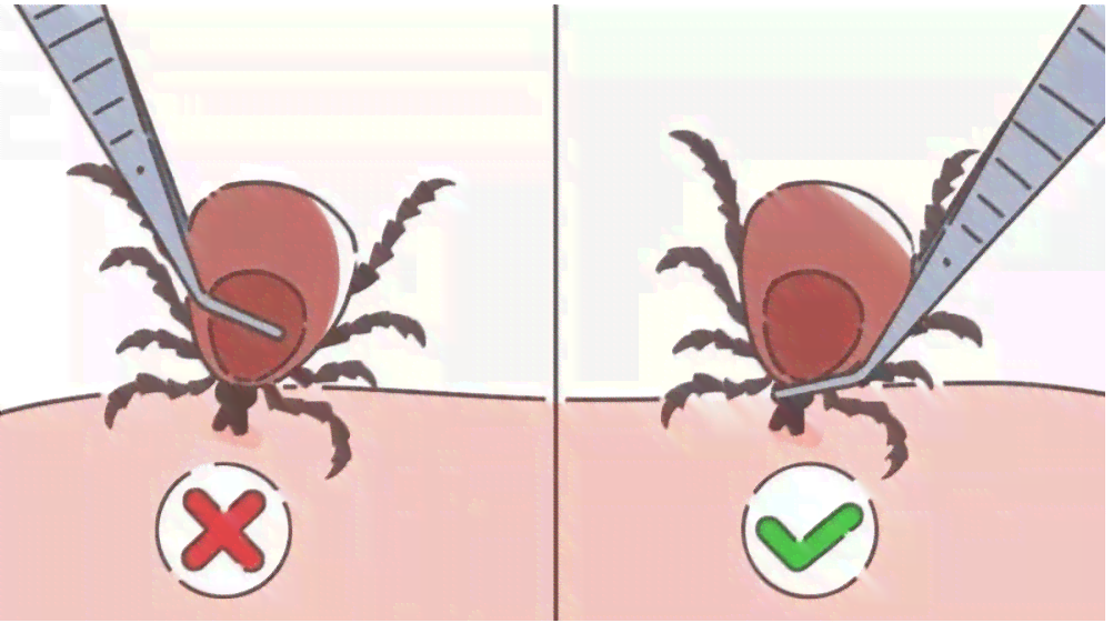 探讨蜱虫叮咬：意外还是可预防的风险？
