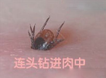 探讨蜱虫叮咬：意外还是可预防的风险？