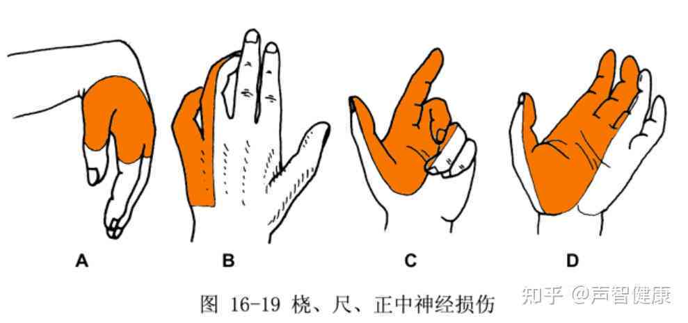 桡神经损伤患者如何评定残疾等级及评残标准解析
