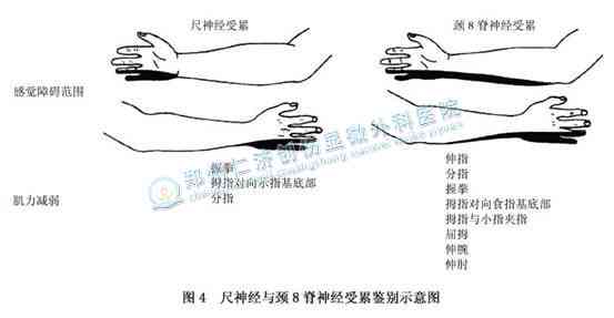 桡神经损伤患者如何评定残疾等级及评残标准解析