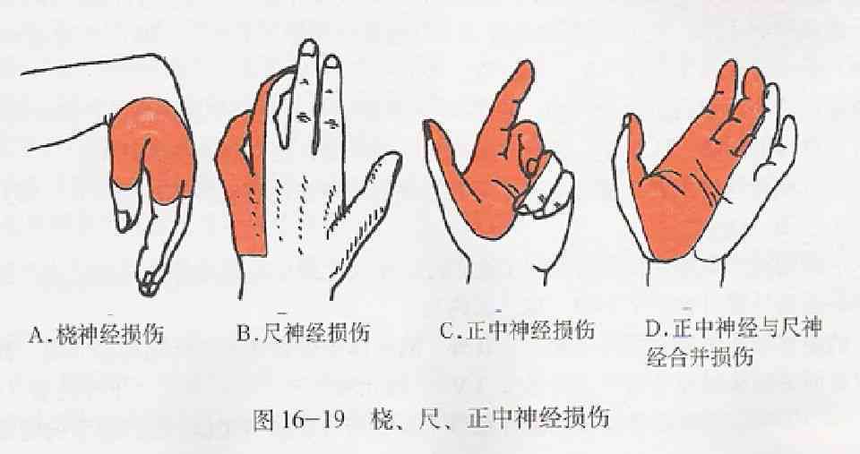 桡神经损伤患者如何评定残疾等级及评残标准解析