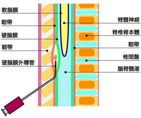 棘间韧带损伤认定工伤几级：自愈可能性、临床症状及常见脊柱节解析