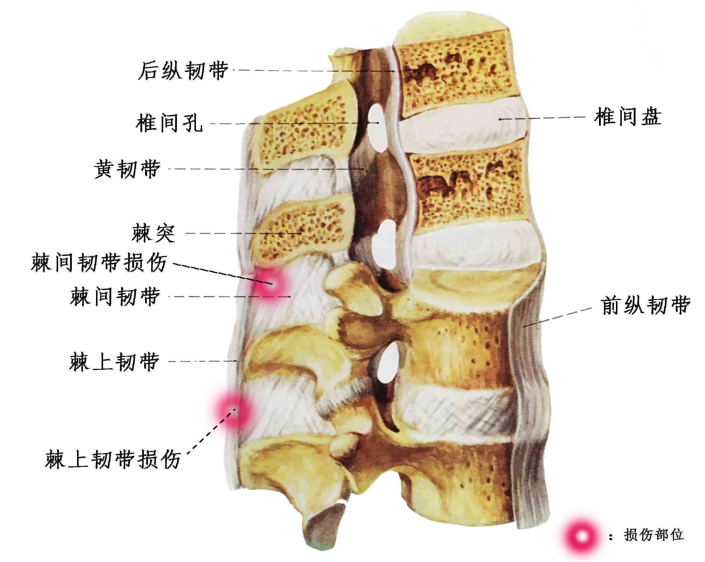 棘间韧带炎手术治疗可行性探讨与方案选择