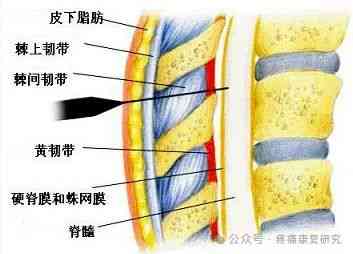 棘间韧带炎：科学治疗，重拾健生活