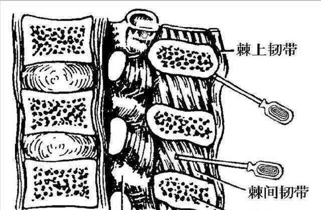 棘间韧带炎：科学治疗，重拾健生活