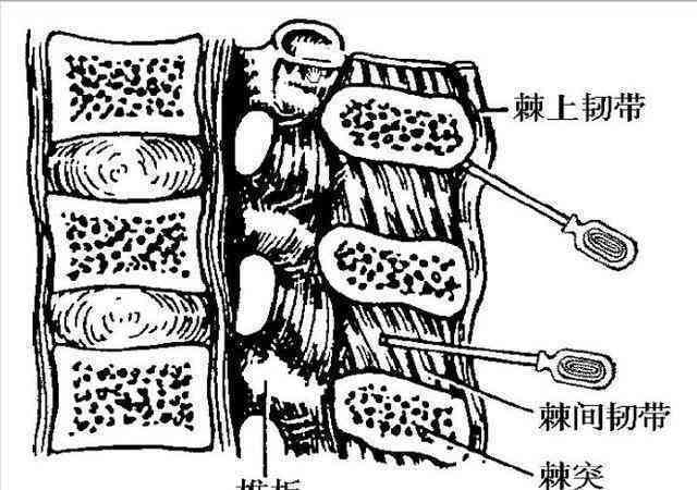 棘间韧带炎能认定工伤吗