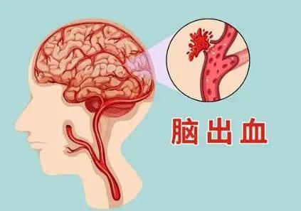 植物人再次脑出血：症状、治疗、存活时间及救治可能性探讨