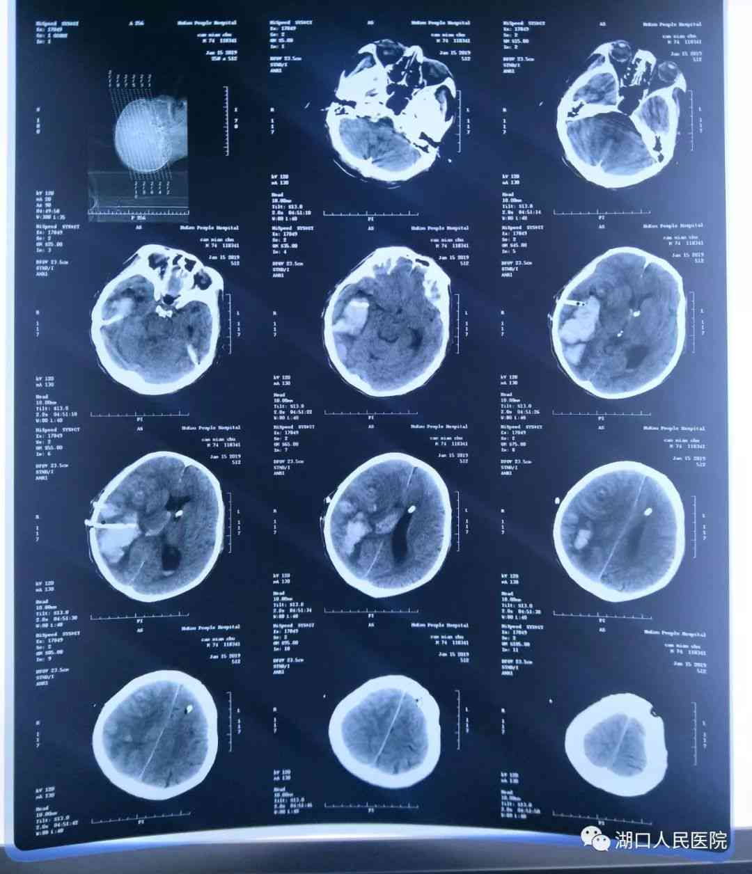 脑出血成植物人的果报：生存期限、恢复可能性及状态解析
