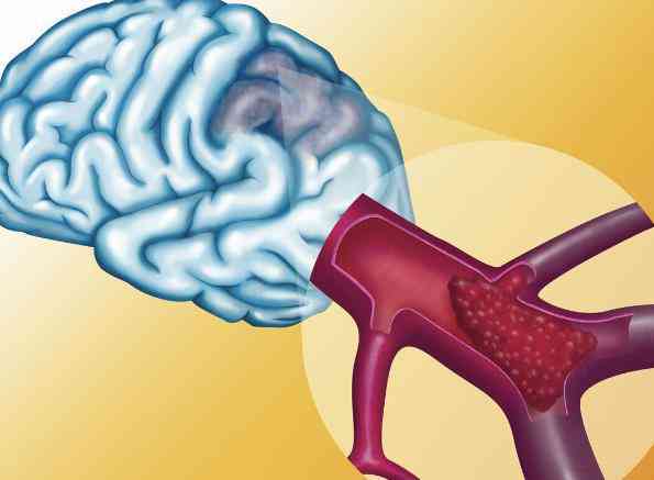 脑出血成植物人的果报：生存期限、恢复可能性及状态解析