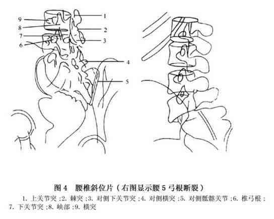 椎峡部裂能不能认定工伤及其工伤等级认定探讨