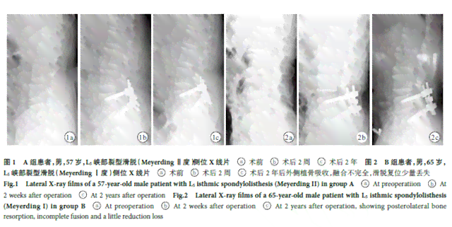 腰椎椎崩裂治疗与复：探讨手术与非手术疗法及其效果对比