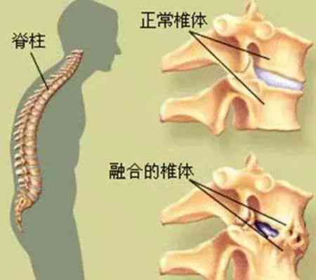 椎崩裂会自愈吗 女性能自行痊愈或恢复吗