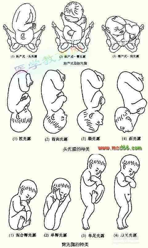 椎崩裂患者怀孕期间注意事项与安全指南