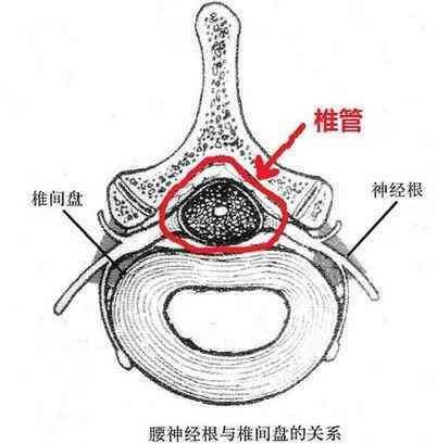 椎管狭窄：工作原因导致的损伤能否被认定为工伤？