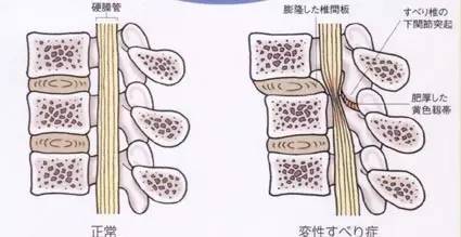 椎管狭窄：工作原因导致的损伤能否被认定为工伤？