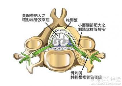 椎管狭窄：工作原因导致的损伤能否被认定为工伤？