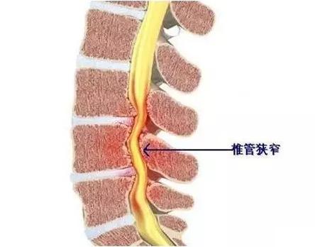 椎管狭窄伤残鉴定全解析：涵等级划分、评定标准及赔偿指南