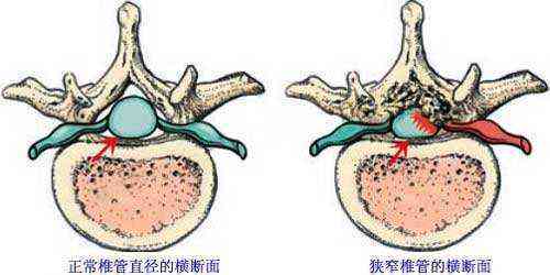 椎管狭窄还能工作吗：影响干活、生育与复活动能力解析