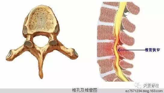 椎管狭窄还能工作吗：影响干活、生育与复活动能力解析