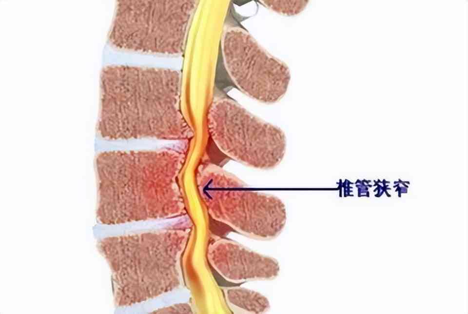 椎管狭窄可以认定工伤吗