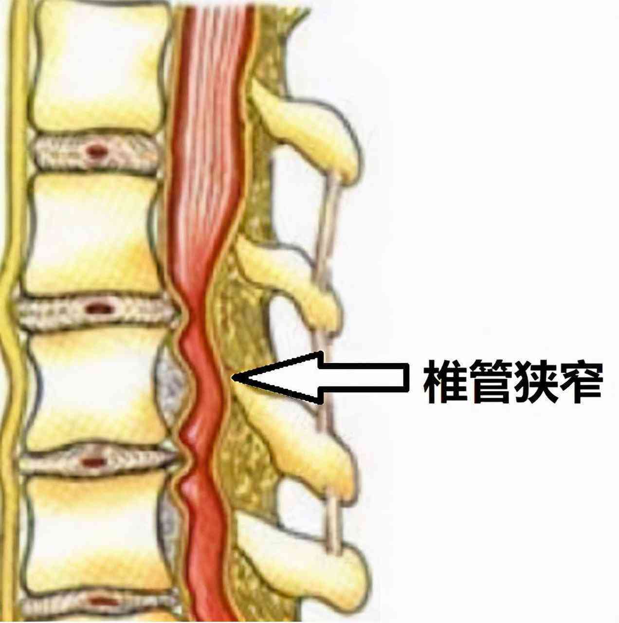 椎管狭窄可以认定工伤吗
