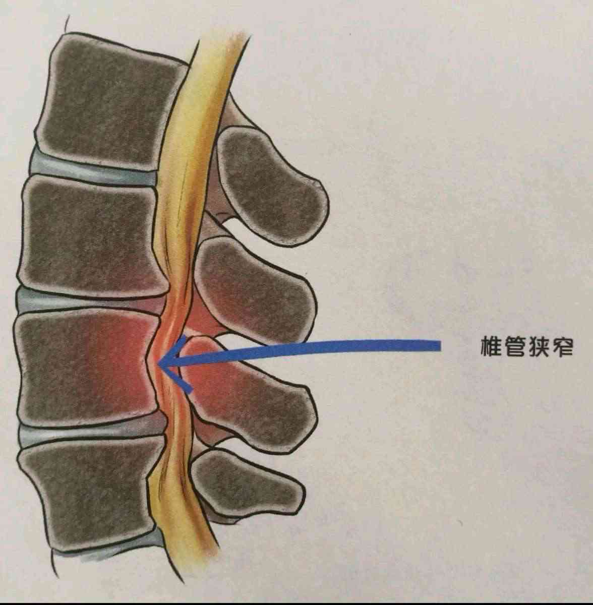 椎管狭窄可以认定工伤吗